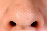 6 thói quen khiến mụn đầu đen dai dẳng hơn, nhiều người vẫn mắc phải mỗi ngày