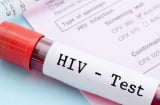 Dấu hiệu HIV trên cơ thể: Những biểu hiện âm thầm dễ bị bỏ qua