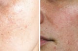 3 nguyên tắc chăm sóc da giúp cải thiện nám sau sinh và lấy lại làn da sáng khỏe