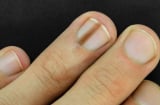Những dấu hiệu bất thường ở móng tay cảnh báo bệnh nguy hiểm