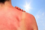 Làn da cháy nắng sau kỳ nghỉ: Những bước phục hồi giúp da nhanh dịu, khỏe và đều màu trở lại