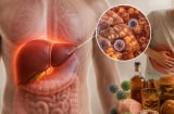 Những dấu hiệu này thì đừng chủ quan: Gan đang 'kêu cứu' nhưng nhiều người bỏ qua
