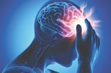 Căng thẳng kéo dài âm thầm tàn phá mạch máu, tăng nguy cơ đột quỵ