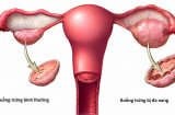Đa nang buồng trứng đổi tên sau 90 năm - Nhiều phụ nữ từng bị hiểu sai