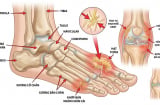 Acid uric tăng cao: 5 biểu hiện dễ bị bỏ qua, nhiều người chỉ phát hiện khi gout đã xuất hiện