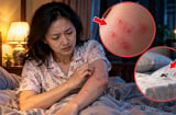 Mẩn ngứa đỏ mỗi đêm có phải bệnh không?