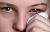 3 dấu hiệu cảnh bào bệnh ung thư mắt