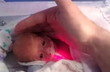 Sinh sớm hơn 3 tháng nặng 0,56kg, bé sơ sinh sống sót kì diệu nhờ túi nhựa