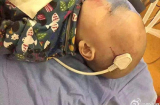 Thương tâm: Bé trai 2 tuổi ngã từ giường xuống đất bị phích cắm 3 chân xiên não