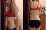 Cô gái 'xương khô' chỉ nặng 25,5kg bất ngờ sở hữu thân hình 'chuẩn như người mẫu'