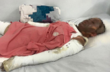 Xót thương: Người phụ nữ bị hủy hoại khuôn mặt, 2 tay cháy đen vì ngủ quên khi nấu cháo