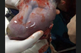 Bé gái sinh ra chỉ nặng 800 gram còn nguyên trong bọc ối khiến bác sĩ ngỡ ngàng
