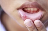 Những dấu hiệu cảnh báo ung thư miệng bạn không nên bỏ qua