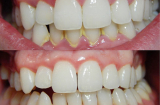 Răng trắng bóc chỉ trong 1 phút cả đời không cần lấy cao răng