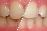 Các cách loại bỏ cao răng hiệu quả mà bạn nên biết