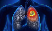 Top 5 thực phẩm là “máy hút bụi” cho phổi, càng ăn phổi càng được lọc sạch mỗi ngày