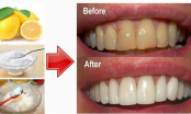 Cách tẩy trắng răng tại nhà an toàn và hiệu quả nhất, răng trắng hơn mỗi ngày