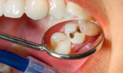 Thấy răng xuất hiện điểm lạ này cần đi kiểm tra càng sớm càng tốt, chớ vội coi thường