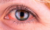 Thấy mắt đỏ ngầu sau khi ngủ dậy hãy đề phòng với căn bệnh nguy hiểm, rất nhiều người mắc phải