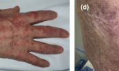 Đây là 5 dấu hiệu điển hình trên da người mắc Covid-19, mọi người cần chú ý
