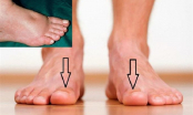 Muốn biết thận khỏe mạnh hay không, cứ nhìn vào 5 điểm ở bàn chân là rõ