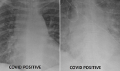 Bác sĩ chỉ điểm khác biệt đầy kinh ngạc khi so sánh ảnh chụp phổi bệnh nhân Covid-19 đã tiêm và chưa tiêm vắcxin