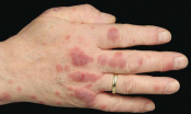 Nhờ vết mẩn đỏ trên tay người đàn ông phát hiện mình mắc bệnh hiểm nghèo: 6 dấu hiệu nhận biết