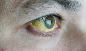 Lòng trắng của mắt có màu vàng có phải bị viêm gan? Có 3 loại khó chịu ở mắt thì kiểm tra gan sớm
