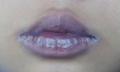 Chuyên gia cảnh báo F0 nhiễm Omicron thấy dấu hiệu này trên môi phải vào viện ngay lập tức