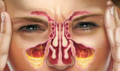 8 biện pháp giúp F0 giảm ngạt mũi, tránh tình trạng khô họng, đau họng
