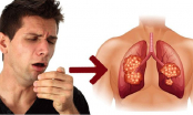 5 dấu hiệu sớm cảnh báo K phổi, nếu thấy có 1/5 cũng phải đi khám ngay