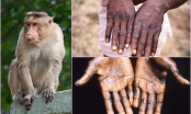 Tất cả những điều cần biết về bệnh đậu mùa khỉ: 4 đường lây truyền, 5 triệu chứng dễ nhầm lẫn
