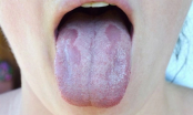 Lưỡi bỗng xuất hiện đốm trắng là dấu hiệu của bệnh gì? Trường hợp đặc biệt có thể là bệnh ung thư nguy hiểm