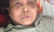 Hà Nội: Mẹ chồng nhập viện vì con dâu đưa người về nhà hành hung