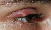 Mẹo hay chữa lẹo mắt “thần tốc” tại nhà không để lại sẹo