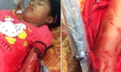 Bé gái 12 tuổi bị kẻ bịt mặt găm dao vào tay đêm Noel