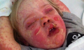 Khuôn mặt dị ứng đáng sợ của bé trai 3 tuổi do dùng kháng sinh
