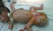 Bản tin phụ nữ 1/10: Phẫu thuật khối u quái cực lớn ở vùng cụt bé sơ sinh hai đầu