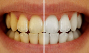 Chỉ mất 3 phút với 2 nguyên liệu dễ tìm có ngay hàm răng trắng sáng