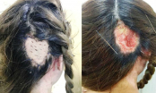 Cảnh báo: Hoại tử vành tai, mất da đầu khi hấp tóc đón Tết