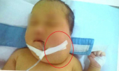 10 giờ phẫu thuật cứu bé gái 20 ngày tuổi mắc khối bướu quái vùng cổ lan lên não đầu tiên ở Việt Nam