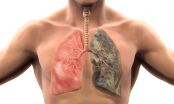 Người hút thuốc lá lâu năm chỉ cần uống hỗn hợp nước này vào cũng thanh lọc phổi ngay lại ngừa ung thư