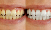 3 cách siêu đơn giản làm trắng răng hiệu quả ngay tại nhà