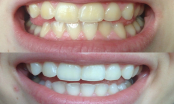 Loại bỏ cao răng mảng bám, răng trăng sáng bất ngờ nhờ thường xuyên làm điều này