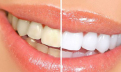 Cao răng bật ra từng mảng dù dày tới đâu ngay lập tức cho răng sáng bóng chỉ với 1 ngàn