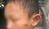 Quảng Ngãi: Bé trai 5 tuổi bị dì ruột đánh bầm tím, rỉ máu khắp người