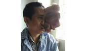 Hi hữu: Người đàn ông khốn khổ mang khối u nặng 4 cân trên khuôn mặt suốt 14 năm