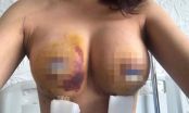 Nữ khách hàng tố bệnh viện làm hỏng ngực: Đề nghị thành lập Hội đồng chuyên môn