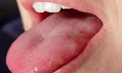 Biểu hiện không ngờ cảnh báo ung thư vòm họng cần đi khám gấp đừng nhầm lẫn với viêm họng