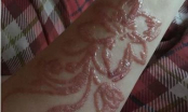 Cô gái trẻ bị bỏng hóa học, mang sẹo cả đời vì xăm henna